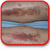 Gejala Penyakit Eksim Atau Dermatitis