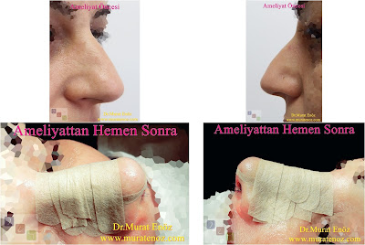 Female Nose Aesthetic Surgery - Nose Jobs For Women - Nose Reshaping for Women - Best Rhinoplasty For Women Istanbul - Female Rhinoplasty Istanbul - Nose Job Surgery for Women - Women's Rhinoplasty - Nose Aesthetic Surgery For Women - Female Rhinoplasty Surgery in Istanbul - Female Rhinoplasty Surgery in Turkey