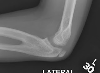 Radioulnar Synostosis, revisited | Congenital Hand and Arm Differences ...