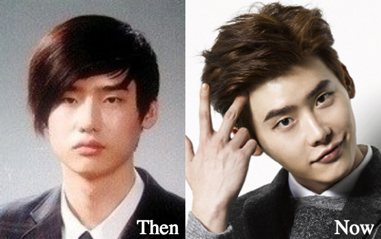 Kim hyung jun plastic surgery