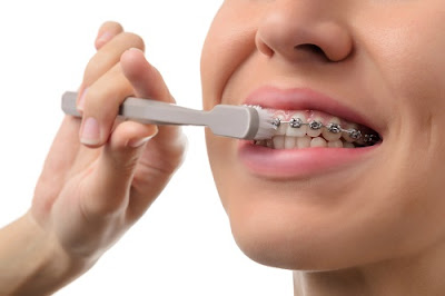 Giải thích niềng răng có ảnh hưởng đến sức khoẻ không 2