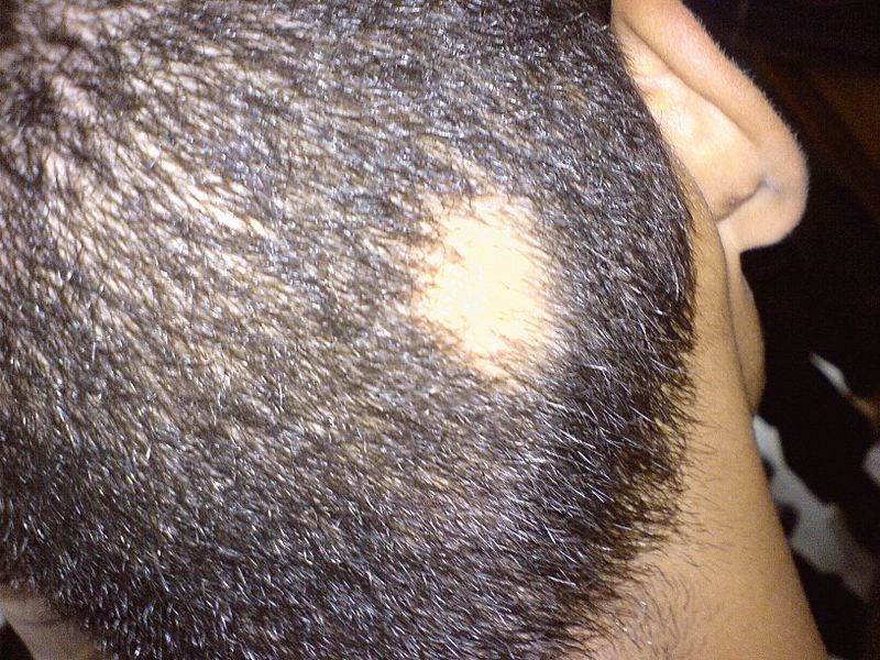 Symptoms Of Symptoms Of Zinc Deficiency In Adults