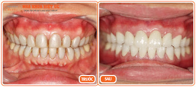 Giải pháp hiệu quả nhất cho răng bị xỉn màu Boc-rang-su-gia-bao-nhieu-la-hop-ly