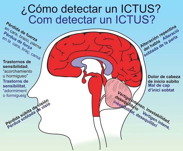 Por que se producen los ictus