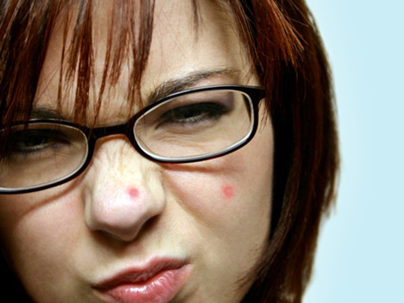 Merawat wajah berjerawat | Sehat dan Bugar