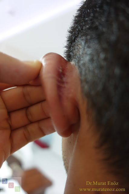 İple kepçe kulak ameliyatı - Mustarde Tekniği İle Kepçe Kulak Estetiği - Matris dikiş tekniği ile kepçe kulak düzeltilmesi