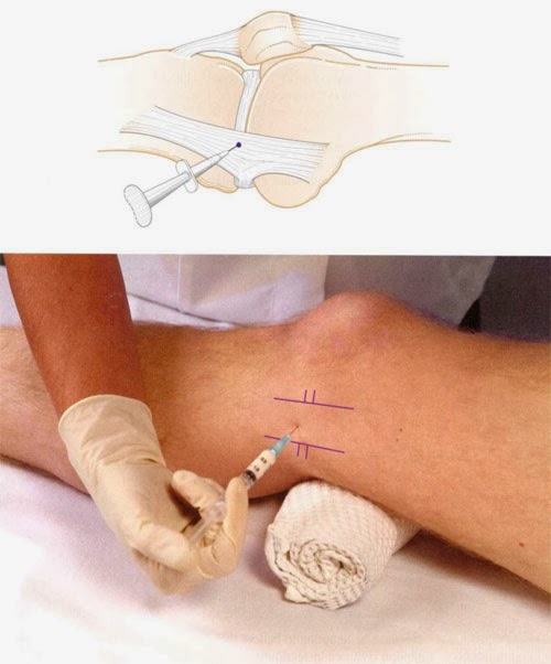 Medical Collateral Ligament Injection ~ Nursing