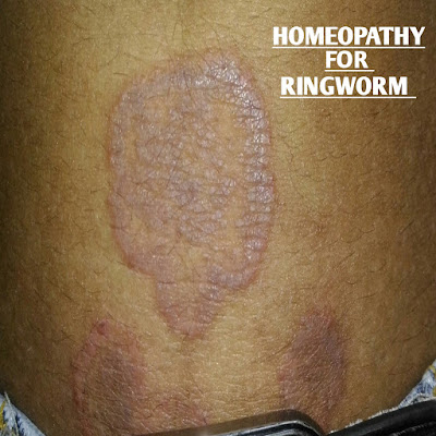 Homeopathy for Ringworm