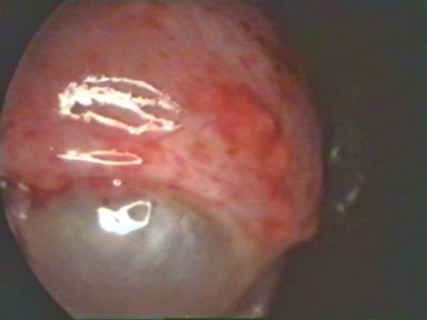 Adolescent endometriosis,vesicle and red implants