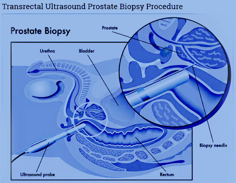 How is a prostate biopsy performed