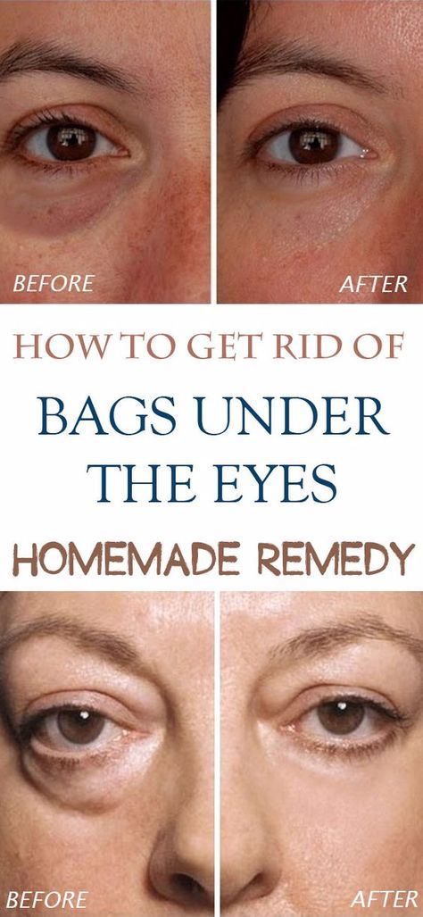 How To Get Rid Of Bags Under The Eyes How To Beauty