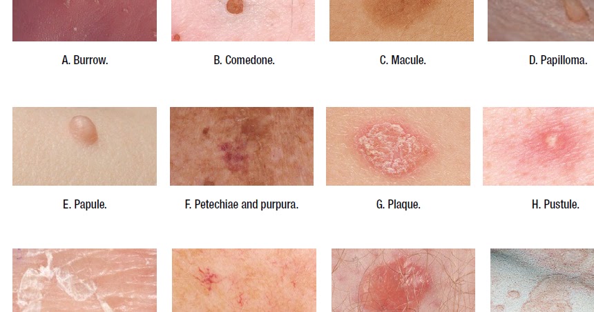 Medical Addicts Terms Used To Describe Skin Lesions