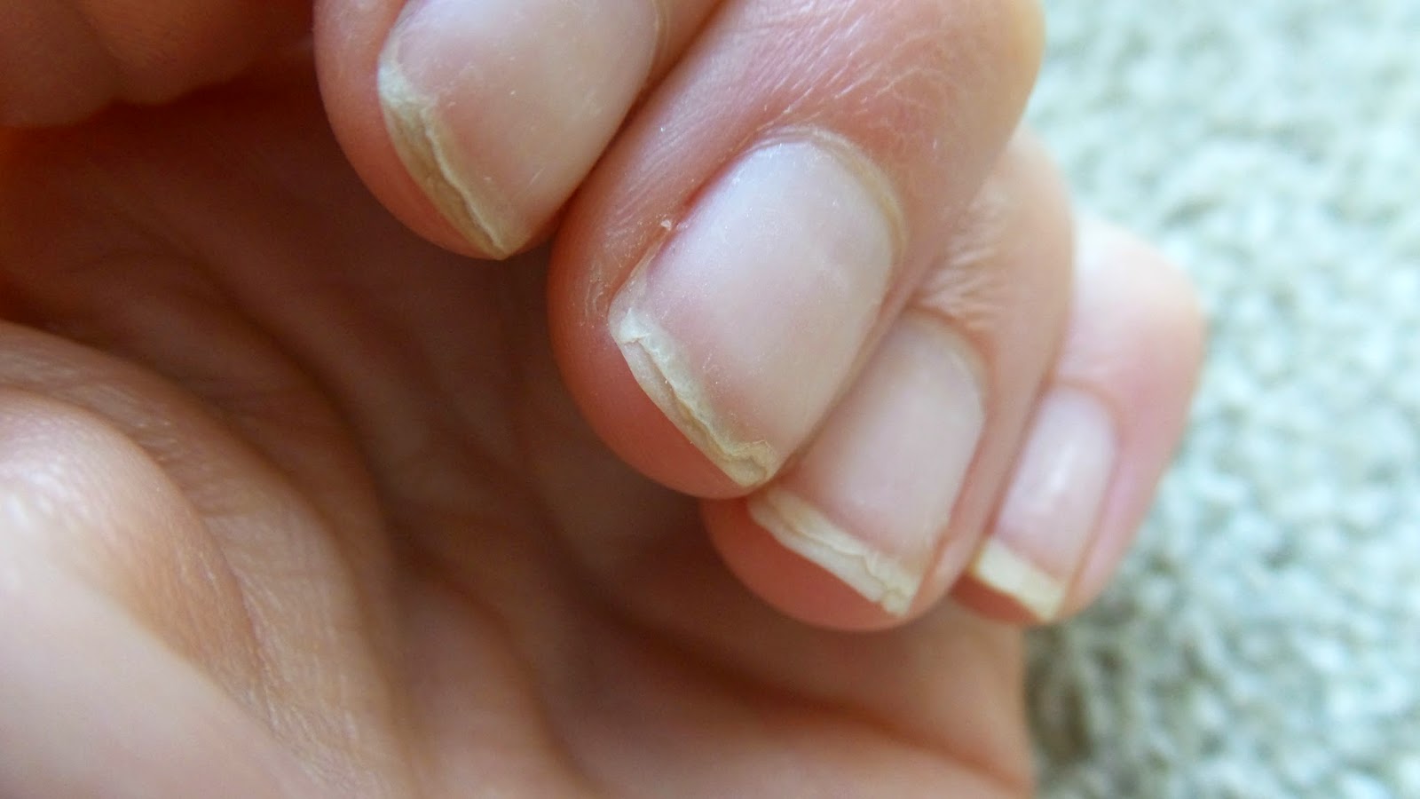 Nail Treatments For Damaged Nails | Eltoria