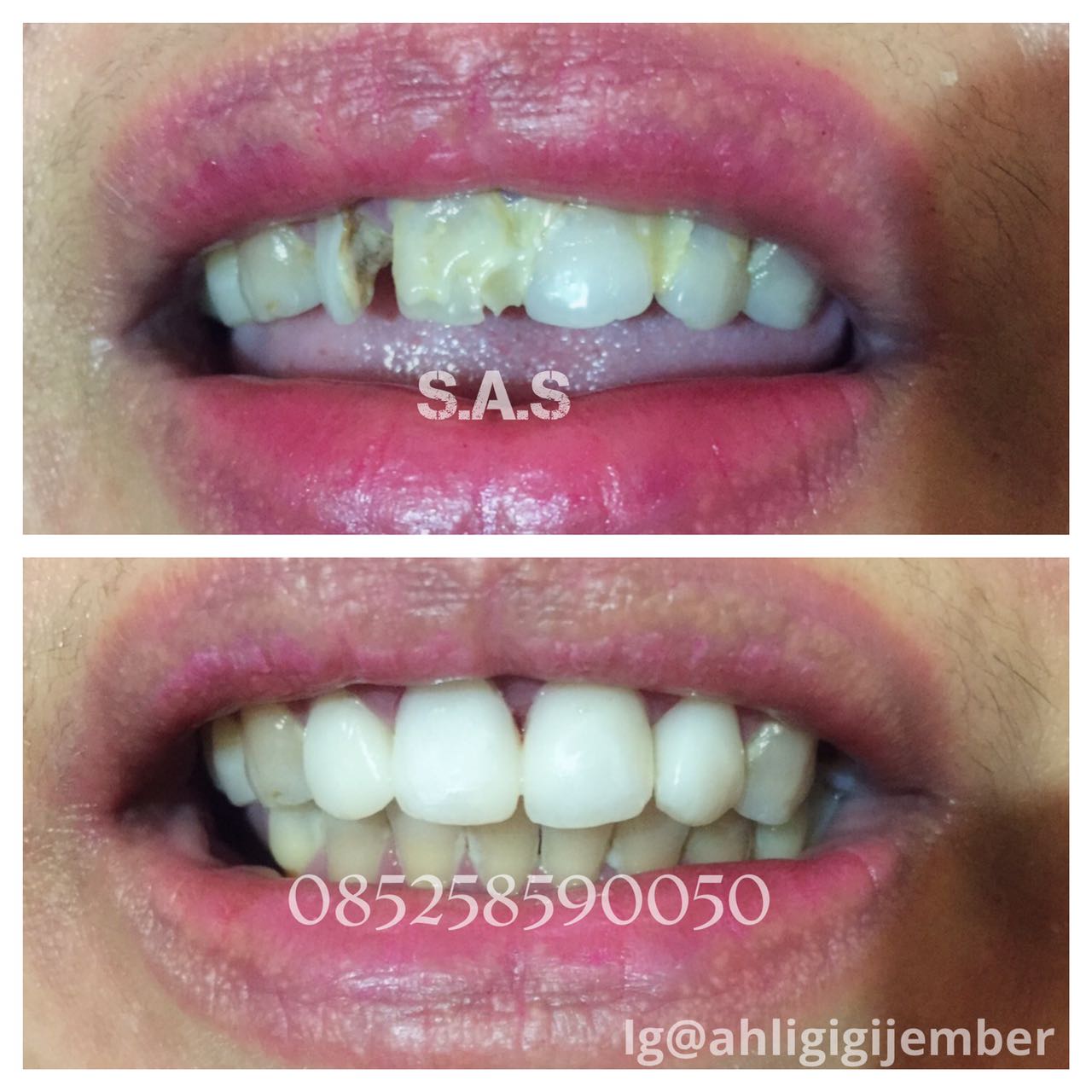 Hasil Perbaikan dari Mengganti Tambalan Lama hingga Merapikan Gigi 