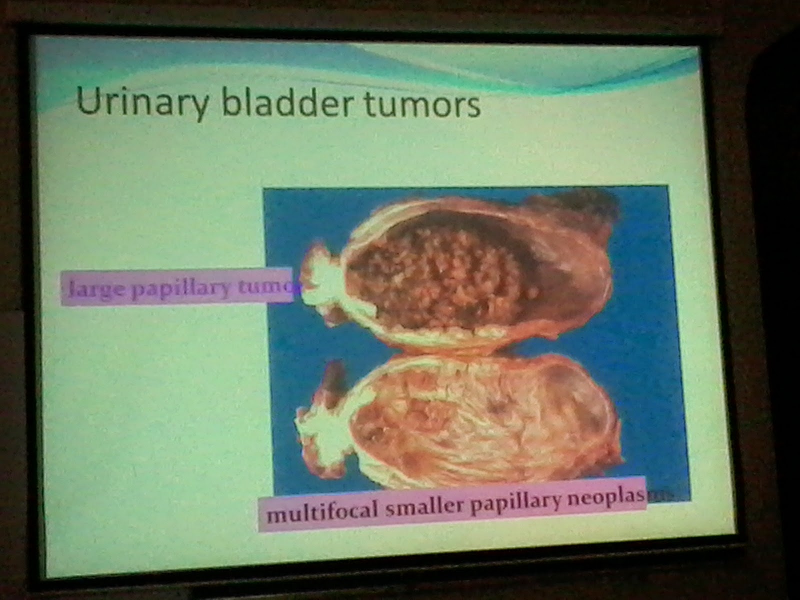 Lecture Slides; Pathology URINARY BLADDER TUMORS