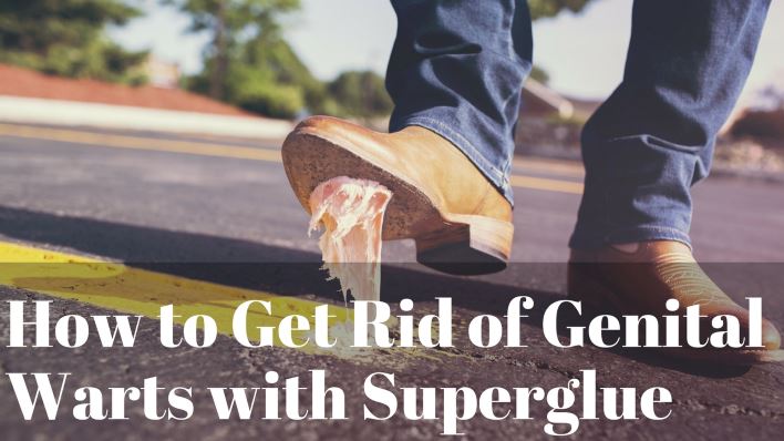 How to Get Rid of Genital Warts with Superglue How to Get Rid of Genital Warts with Superglue