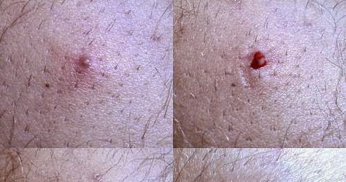 Poliosis Natural Treatment Poliosis Natural Treatment