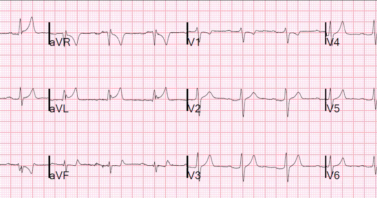 Dr. Smith's ECG Blog: ST Elevation in I and aVL, with reciprocal ST  depression in lead III