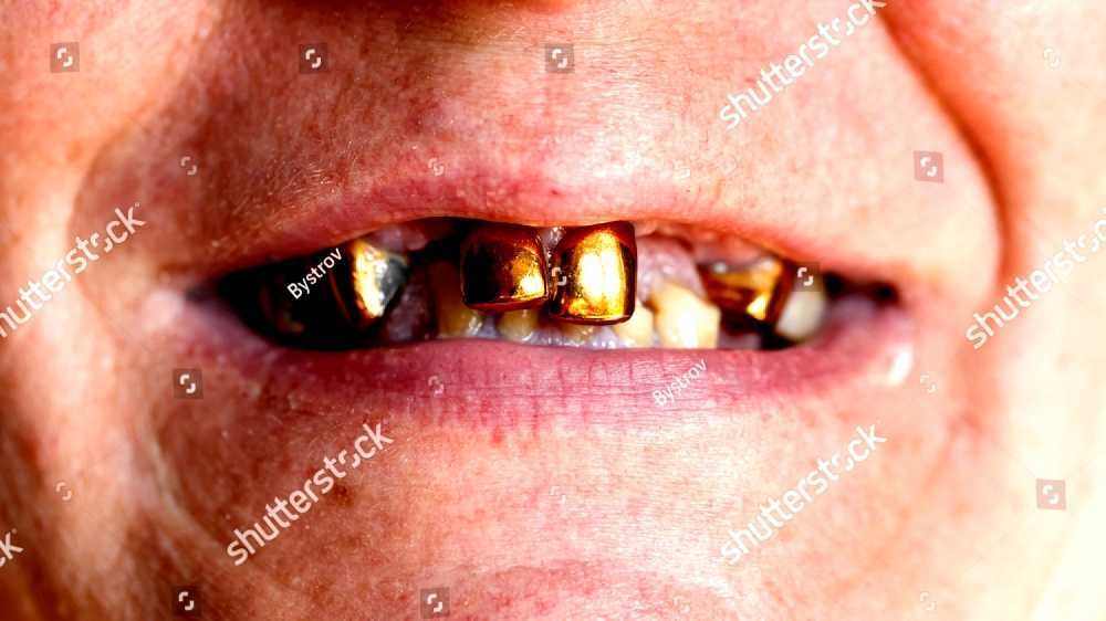 Gold teeth
