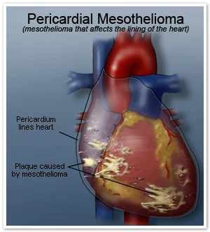Captivating Pericardial Mesothelioma Moment Digital Art