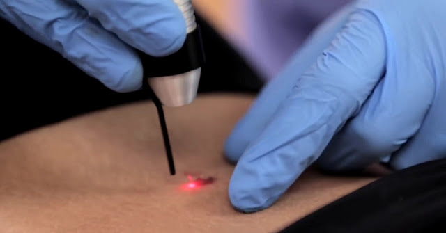 Penggunaan laser untuk menghilangkan tahi lalat