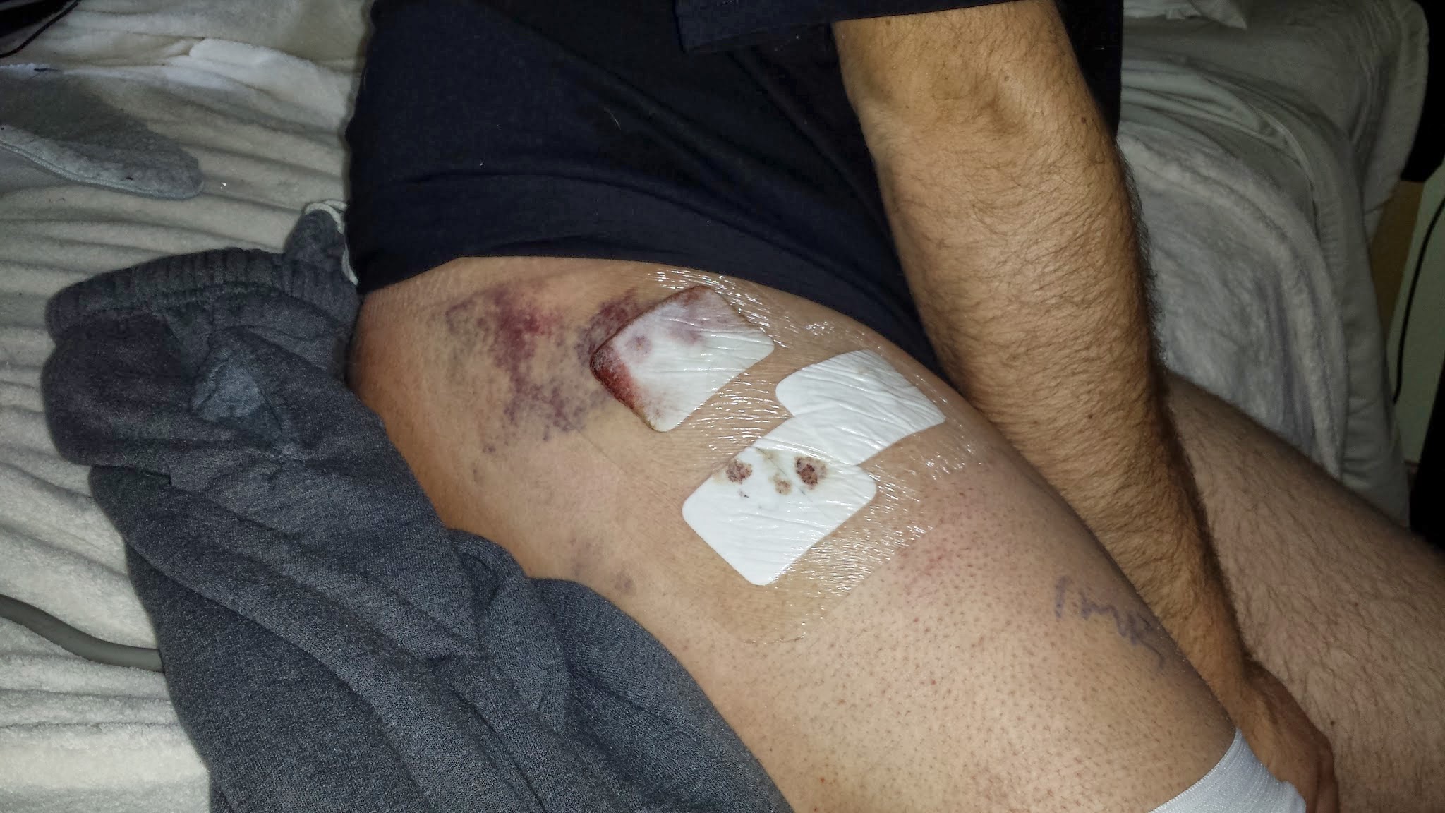 FAI *Femoroacetabular Impingement* Arthroscopic Hip