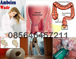 Harga Kapsul Wasir Berdarah Herbal Ambejoss Harga Kapsul Wasir Berdarah Herbal Ambejoss