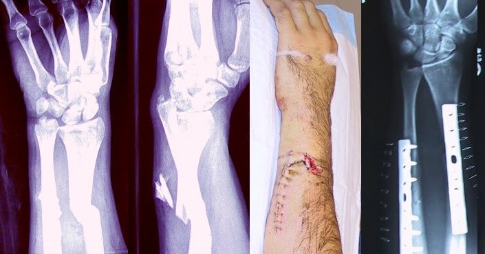 closed fracture vs open fracture closed fracture vs open fracture