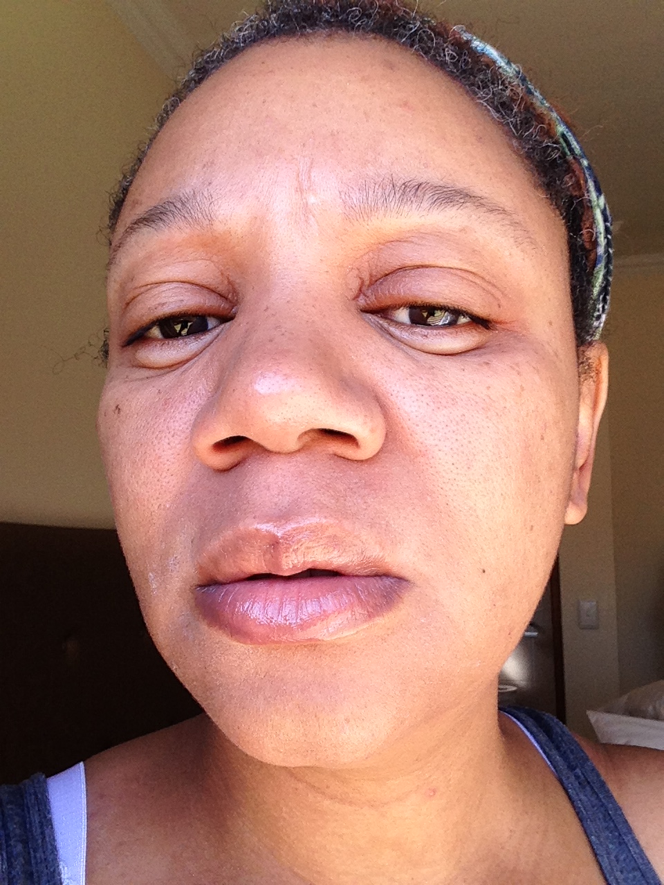 Allergic Reaction To Makeup Swollen Eyes - Mugeek Vidalondon Makeup Allergic Reaction