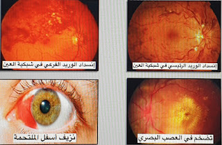 Göz Üzerinde “Yüksek Kan Basıncı” Komplikasyonları.