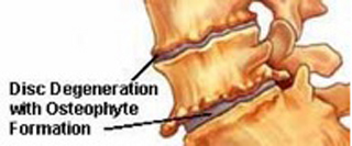 What is Osteophytosis