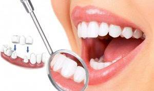 Công nghệ trồng răng sứ có bị hôi miệng?