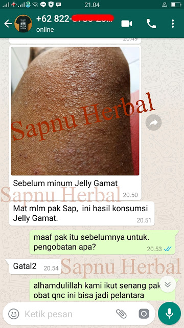 Cara Menghilangkan Bekas Koreng Yang Sudah Lama dan Menghitam Sampai Tuntas Cara Menghilangkan Bekas Koreng Yang Sudah Lama dan Menghitam Sampai Tuntas