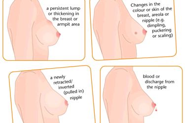 Breast Cancer And Teenage Girls