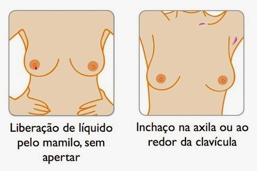 sintomas-cancer-mama-mulher-homem-prevencao-autoexame-mamografia-quimioterapia-dascoisasquetenhoaprendido