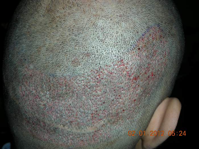 Hair Transplant,Hair Restoration,FUE in Ireland