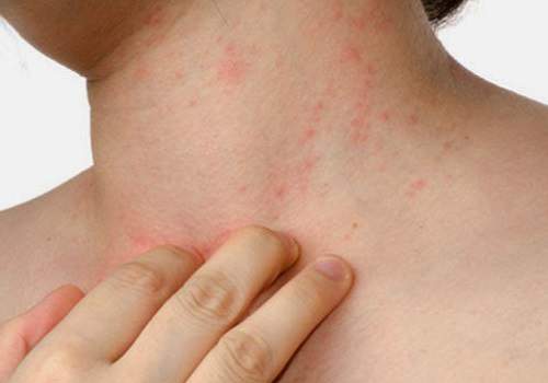 Bahaya, Jangan Mengkonsumsi Vitamin C Teralalu Berlebih