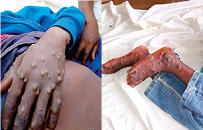 monkey pox virus lagos