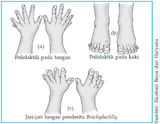 Polidaktili pada tangan (a), polidaktili pada kaki (b), dan brakhidaktili (c).