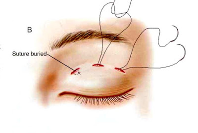 Nhấn mí luồn chỉ