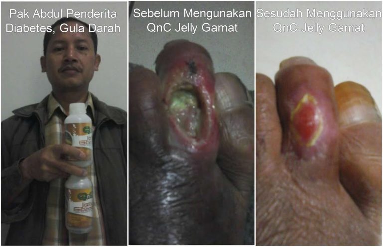 Cara Mengobati Cantengan Parah Bernanah dan Akut Secara Alami Cara Mengobati Cantengan Parah Bernanah dan Akut Secara Alami