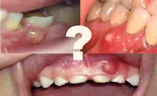 Cara Menghilangkan Sakit Gusi Bengkak - Homecare24