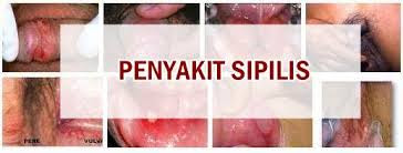 Tahap-tahap Sipilis Infeksi Menular Seksual