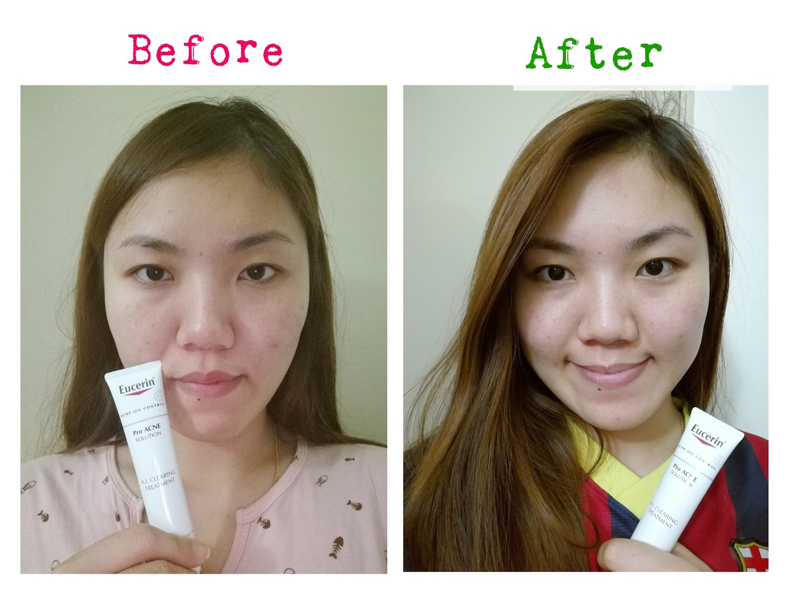Say No to Acne with ProACNE Solution A.I Clearing Treatment -