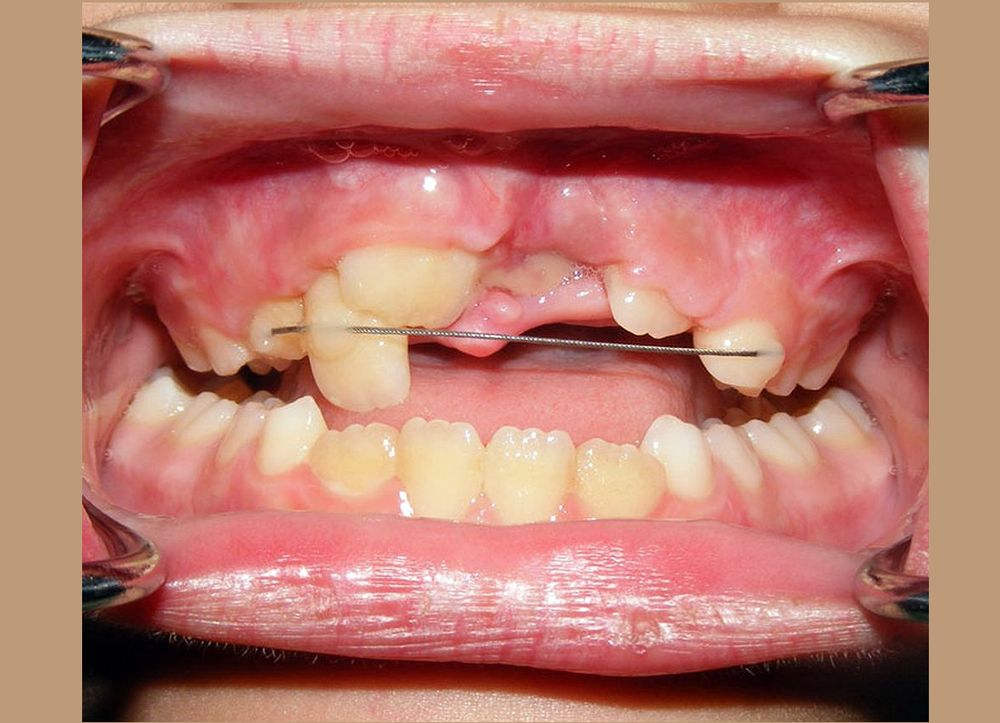 Dental Trauma