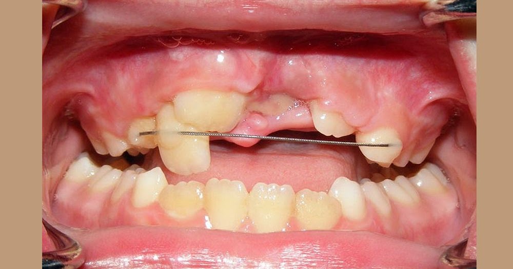 DENTAL TRAUMA Guideline on Management of Acute Dental Trauma odontobebe
