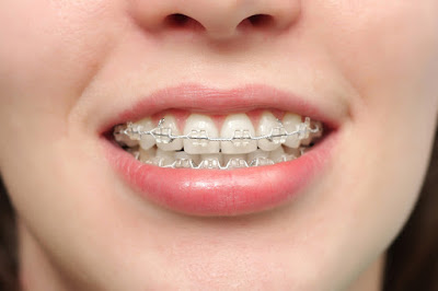 Vì sao niềng răng mắc cài sứ có giá cao hơn kim loại?