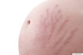 Tips Dermology Stretch Mark Prevention