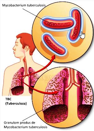 mycobacterium tuberculosis pierdere în greutate