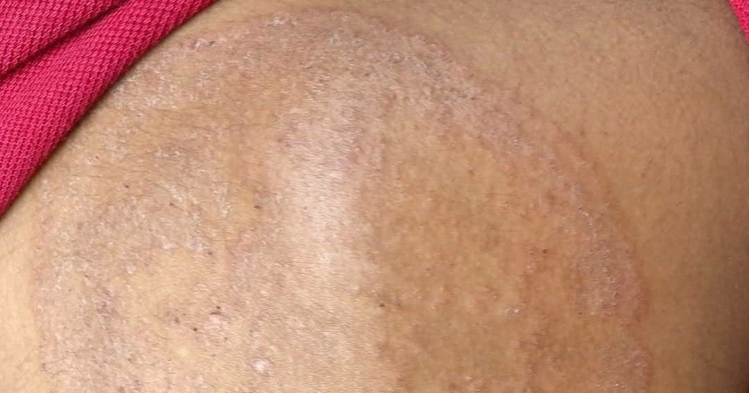 Medicowesome MIL Tinea (Dermatophytosis)